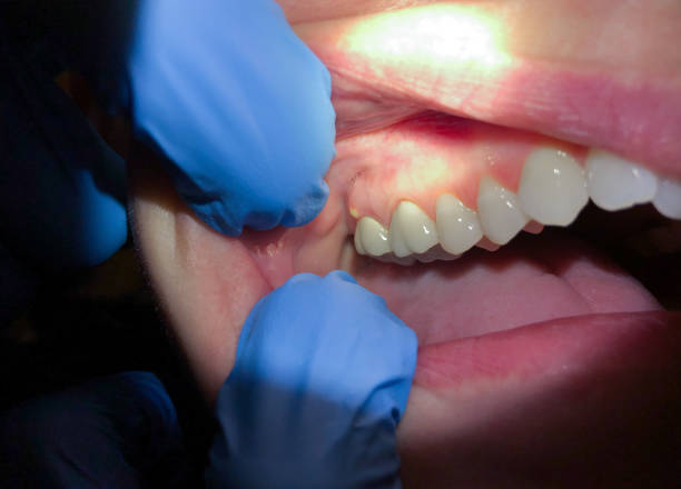 Best Broken or Cracked Tooth Emergency Dentist in Mill Plain, CT