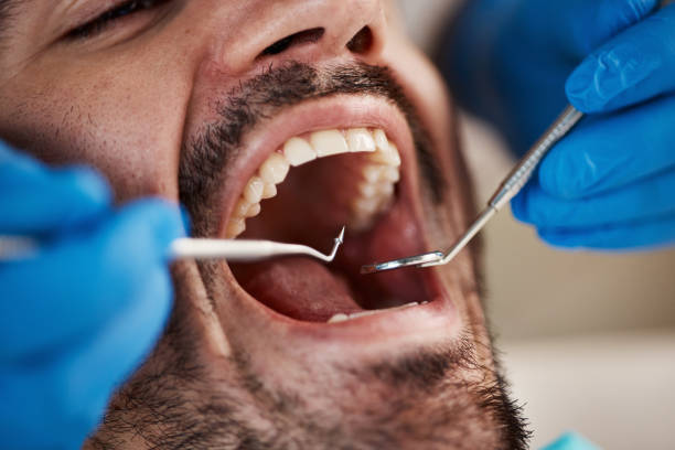 Best Emergency Dentist for Lost Fillings or Crowns in Mill Plain, CT