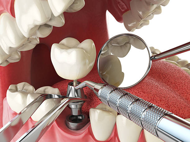 Best Emergency Root Canal Treatment in Mill Plain, CT